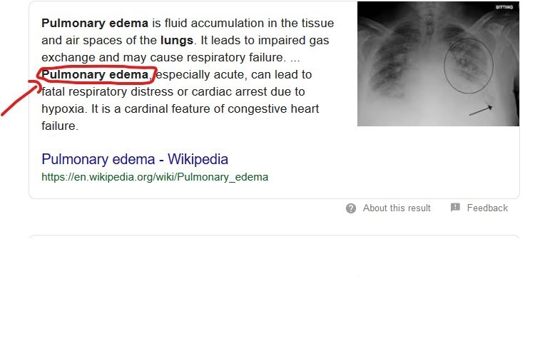 What is pulmonary edema?